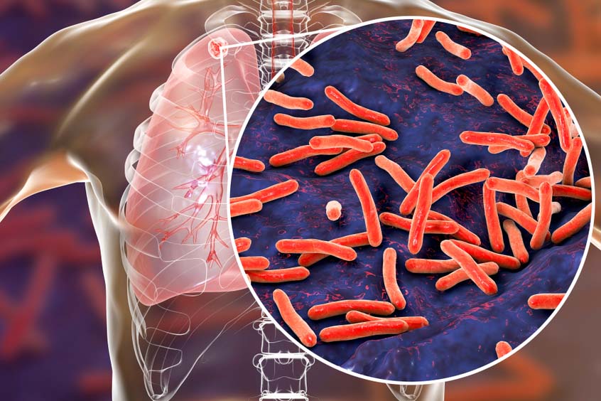 Scientists Develop Rapid Test for Diagnosing Tuberculosis in People With HIV